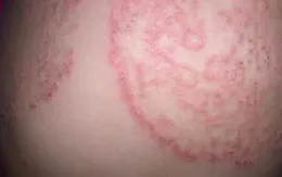 Bệnh nấm da vào mùa hè