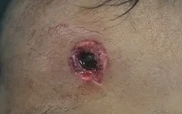 Chơi súng tự chế, trẻ bị đạn bắn găm sâu vào trán