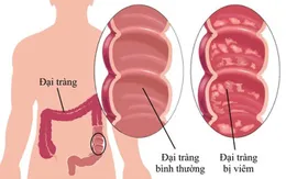 4 nguyên tắc "vàng" đẩy lùi bệnh viêm đại tràng