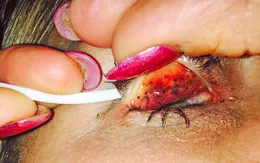 Nguy cơ mù do không tẩy trang mascara