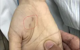 Chủ quan không tiêm phòng:  Một bác sĩ thú y tử vong do bệnh dại