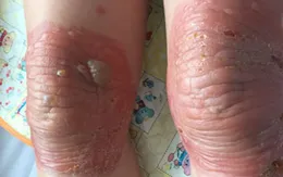 Bỏng đầu gối do bó thuốc nam trị đau khớp