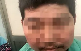 Sưng mặt, chân tay biến dạng vì dùng thuốc đông y không rõ loại