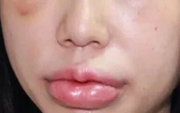 Sưng nề mắt và môi do tiêm chất làm đầy tại thẩm mỹ viện