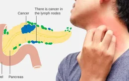 Triệu chứng ung thư tuyến tụy
