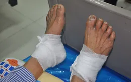 Chườm nóng bằng lá ngải cứu, bệnh nhân đái tháo thường bị bỏng độ 3