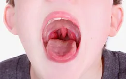 Các dị vật tai mũi họng thường gặp