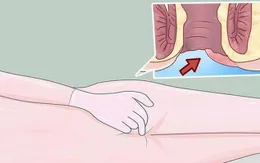Đừng nhầm bệnh trĩ với ung thư hậu môn