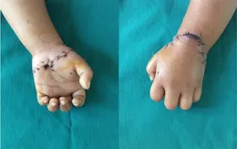 Nối thành công bàn tay đứt rời cho bé gái 31 tháng tuổi