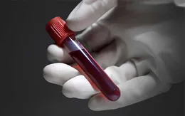Xét nghiệm máu, biết được tuổi thọ