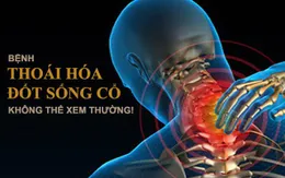 Nguy cơ bại liệt từ bệnh lý thoái hóa đốt sống cổ