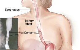 Dấu hiệu cảnh giác với ung thư thực quản