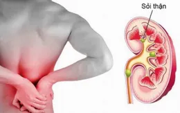 Khám và tư vấn miễn phí bệnh lý sỏi tiết niệu và u tuyến tiền liệt