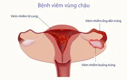 Bùng nổ căn bệnh lây lan qua đường tình dục khiến phụ nữ vô sinh