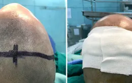 Giải cứu bệnh nhi khỏi hộp sọ hình tam giác