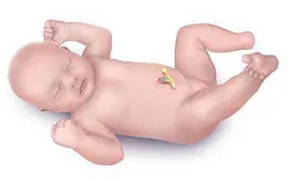 Bệnh phình đại tràng bẩm sinh ở trẻ