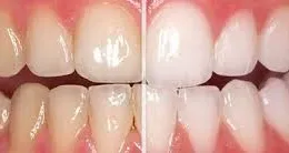 Tại sao răng lại bị chuyển màu ố vàng