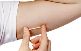 8 điều cần biết về que cấy tránh thai dưới da