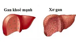 Những điều đáng lưu ý về bệnh xơ gan