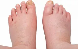 Phù chân – dấu hiệu của nhiều bệnh lý nguy hiểm