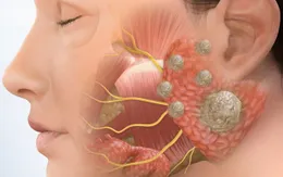 Ung thư tuyến nước bọt - Căn bệnh nguy hiểm