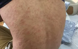 Dị ứng sau khi ăn hải sản