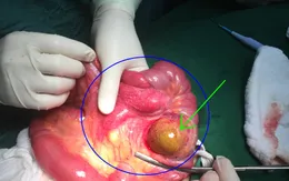 Hy hữu trường hợp lồng ruột ở người lớn