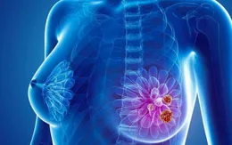 Nguyên nhân gây ung thư vú chị em cần biết