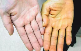 Làm gì để kiểm soát viêm gan B?