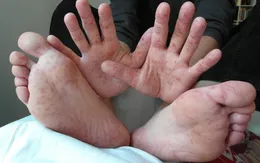 Đồng Tháp: Số ca mắc tay chân miệng tăng 17 lần