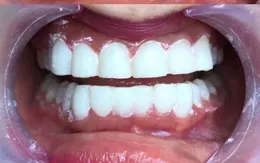 Bản chất của công nghệ “phủ sứ nano” tại các spa thẩm mĩ