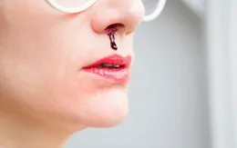 Chảy máu cam ở người già: Nguyên nhân và cách xử trí