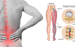 Cây thuốc Nam chữa đau thần kinh tọa