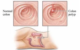 Polyp trực tràng và những điều cần biết