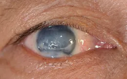 Xác định các chuỗi ADN gây bệnh tăng nhãn áp