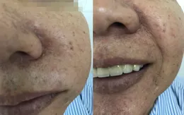 Sưng đau mặt vì u nhầy bành trướng trong xoang hàm