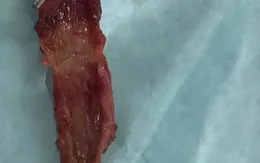 Trẻ sơ sinh bị rò đường mật - khí quản kiếm gặp