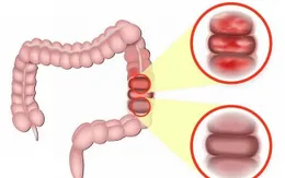 5 biến chứng nguy hiểm của viêm đại tràng mạn tính