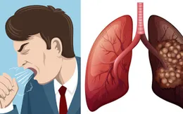 Dấu hiệu nào giúp nhận biết sớm ung thư phổi?