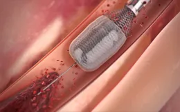 Thiết bị giúp loại bỏ các cục máu đông một cách an toàn