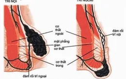 Triệu chứng bệnh trĩ thường gặp