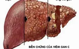 Những hiểu lầm tai hại về bệnh viêm gan virus