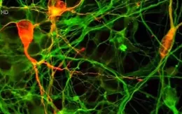 Nhật Bản thử nghiệm điều trị Parkinson bằng tế bào gốc