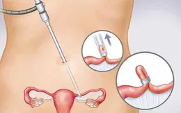 Hơn 240.000 người mắc ung thư buồng trứng mỗi năm