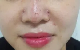 Thêm một ca biến chứng sau khi tiêm filler tại spa