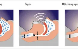 Phát hiện mới ngăn chặn nguy cơ mắc chứng mất trí