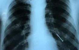 Cây đinh gỉ sét chui vào phổi người đàn ông suốt 4 tháng