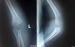 Điều trị chấn thương khó xác định ở bé trai 3 tuổi