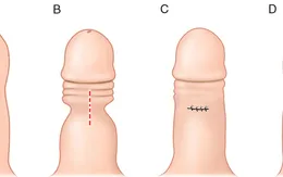 Ảnh hưởng không nhỏ của hẹp bao quy đầu