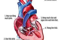 Những điều cần biết về bệnh tim bẩm sinh Tứ chứng Fallot